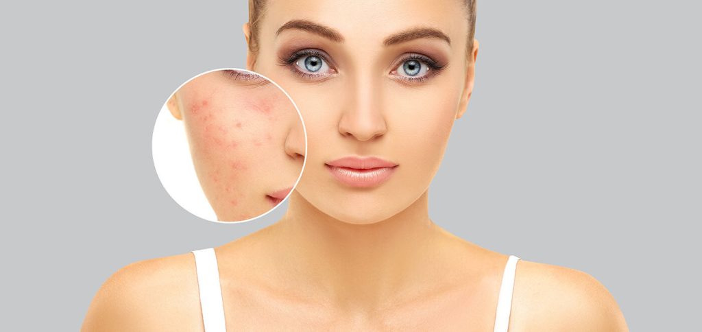 Pigmentation removal from skin